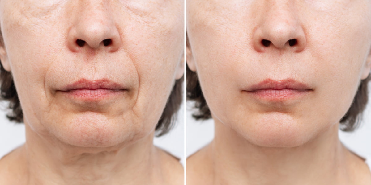 How To Get Rid Of Sagging Jowls 5 Proven Methods