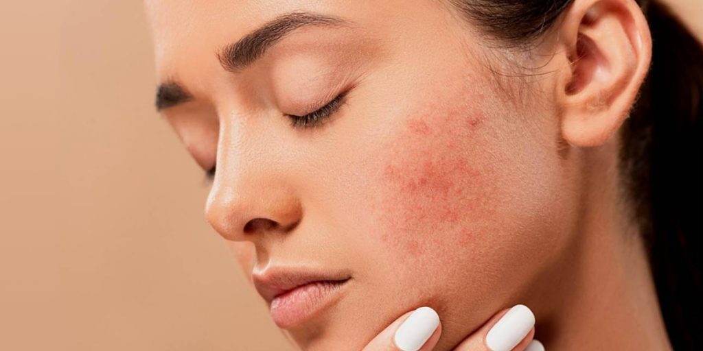 Acne 1024x512 - Redness On Face: Causes And How To Treat It