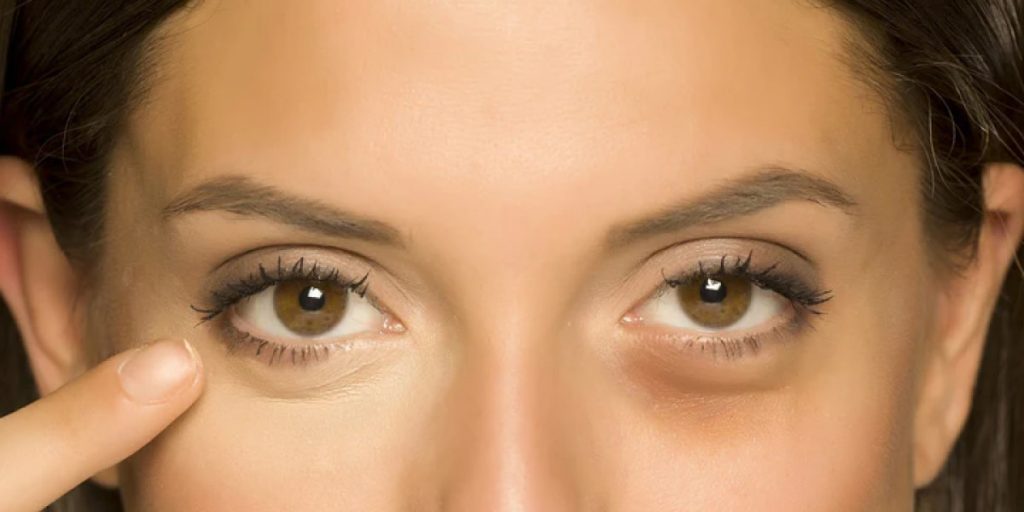 How to prevent eye bags 1024x512 - How To Get Rid Of Bags Under Eyes: Puffiness Under Eyes Removal Guide