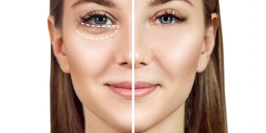 puffiness under eyes before and after
