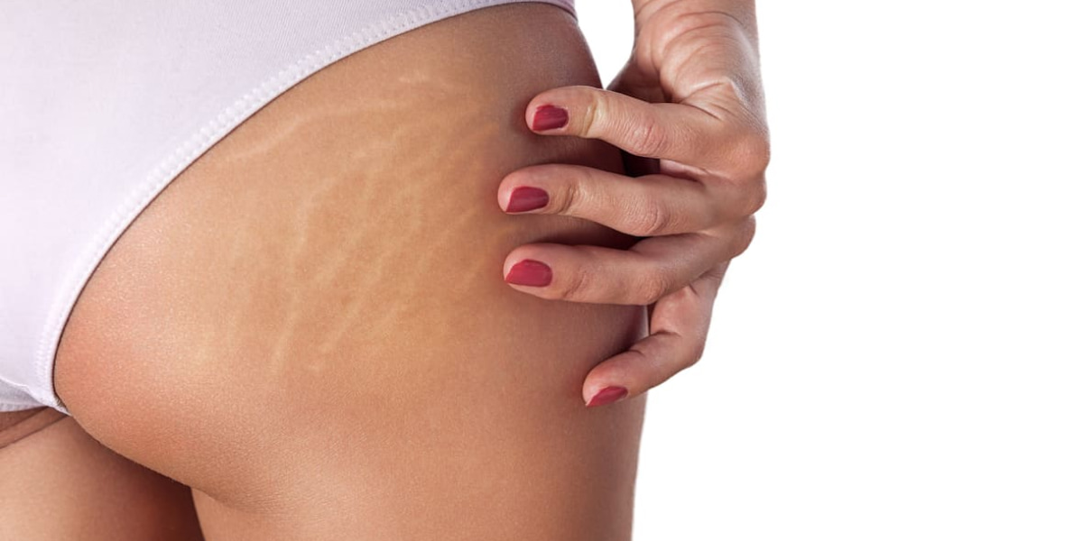 How To Cover Stretch Marks With Makeup?