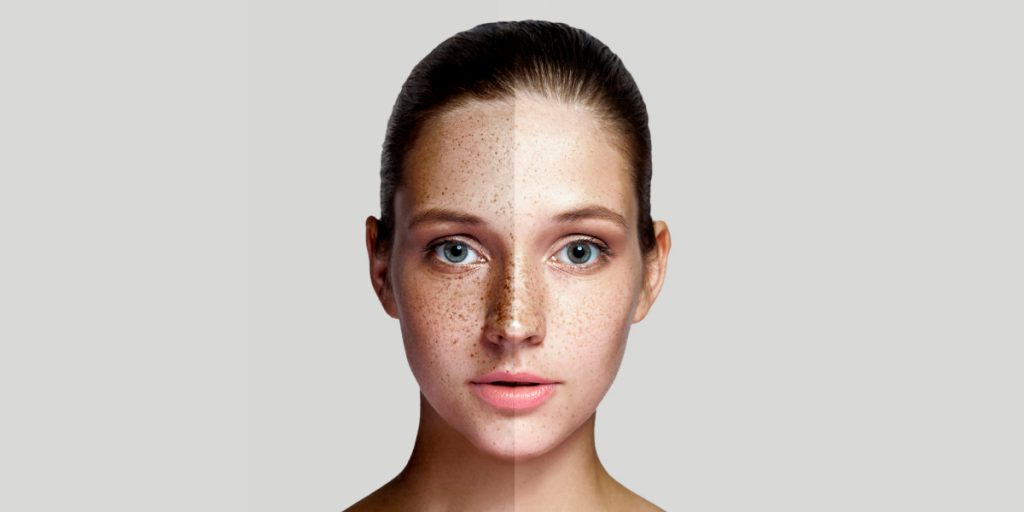 face with hyperpigmentation before and after makeup