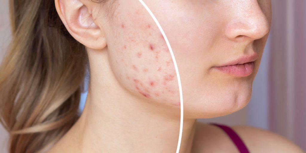 acne scars before and after