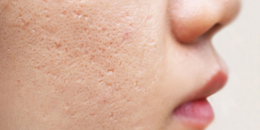 acne scars on woman's cheeck