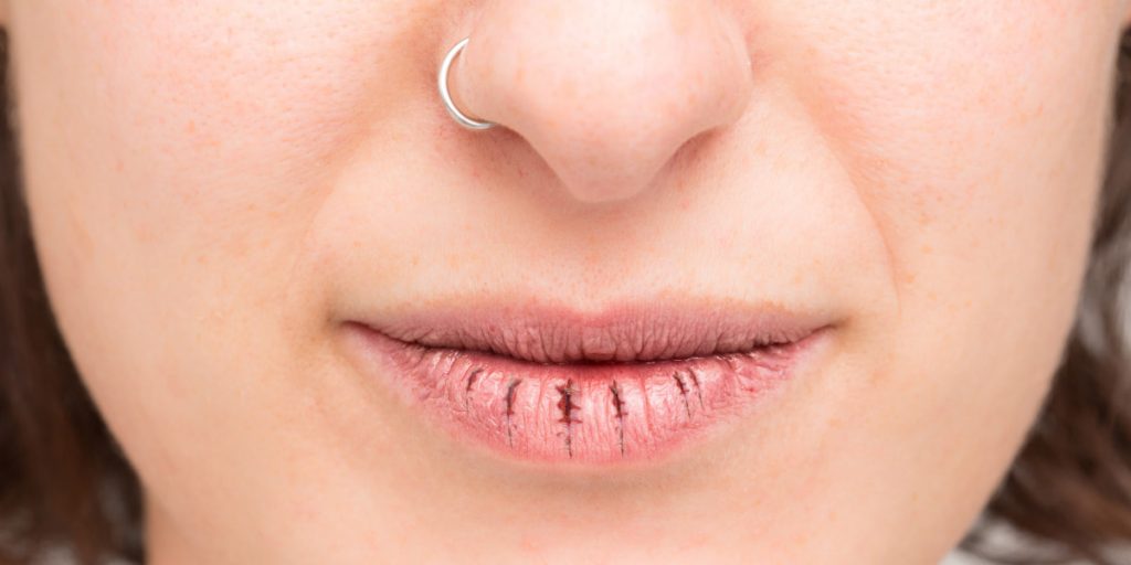 Best ways to heal chapped lips fast and painlessly 1024x512 - How To Prevent Chapped Lips: 16 Best Remedies For Chapped Lips