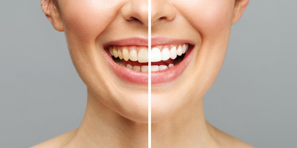 teeth whitening before and after