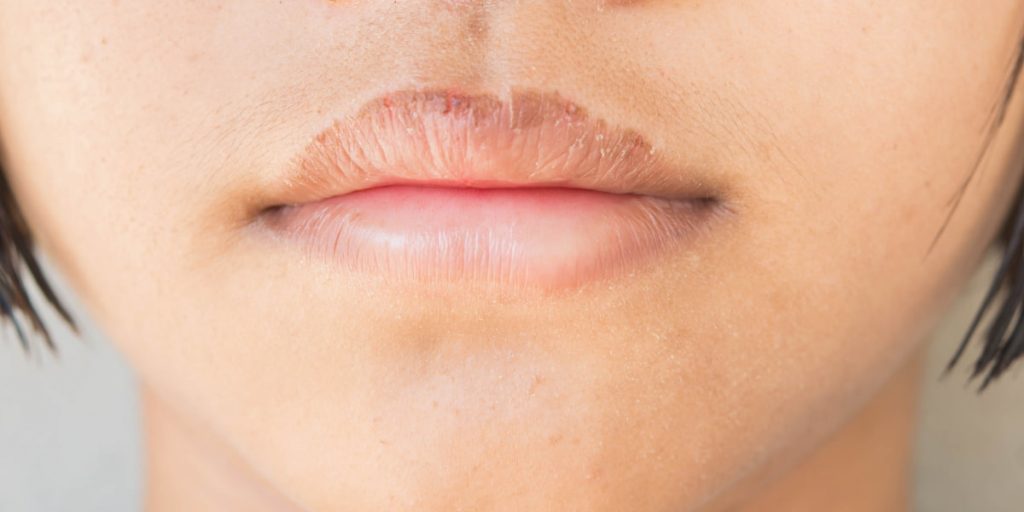 What Causes Chapped Lips 1024x512 - How To Prevent Chapped Lips: 16 Best Remedies For Chapped Lips
