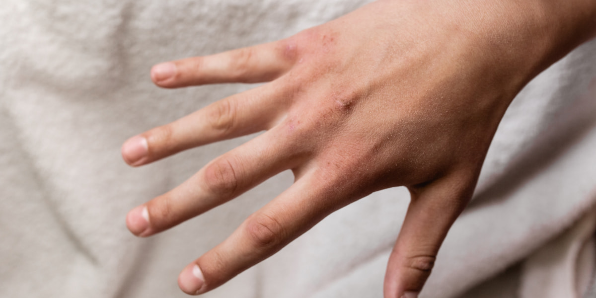 How To Heal Cracked Hands Causes Of Dry And Cracked Hands
