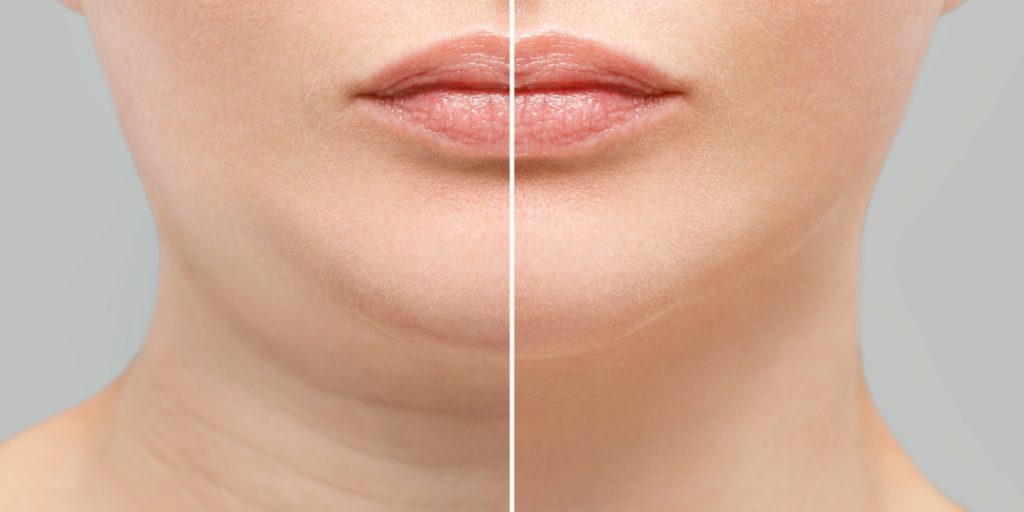 How To Remove Double Chin 5 Working Ways 1024x512 - What Causes Double Chin And How To Prevent It To Appear?