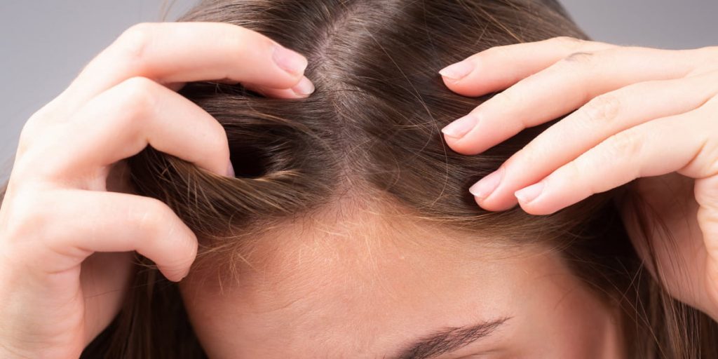 girl with receding hairline