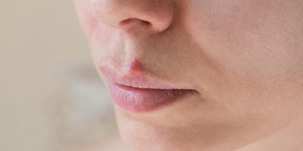 woman with lip pimple 