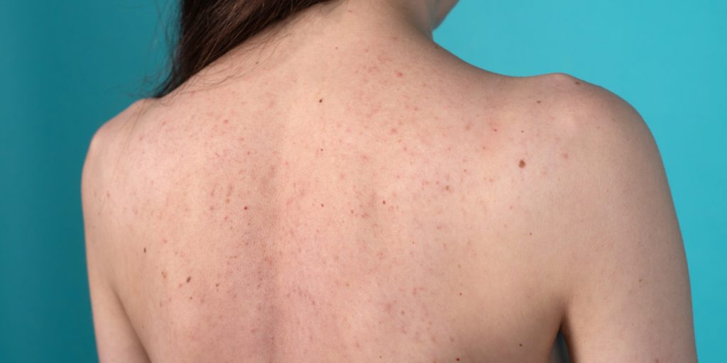 What Are the Types of Back Acne 1024x512 - How To Get Rid Of Back Acne At Home Once And For All?