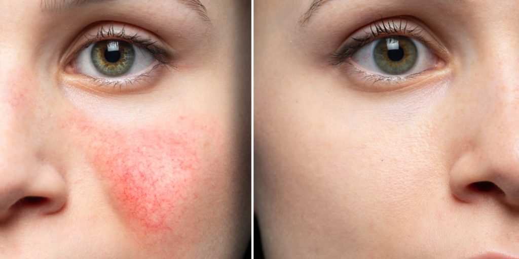 broken blood vessels on the face - before after
