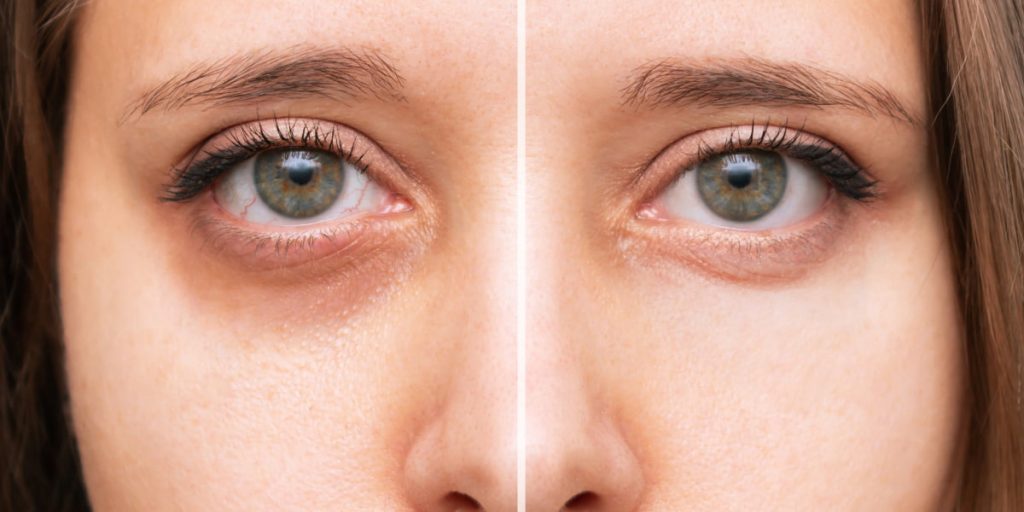 dark circles under the eyes before after