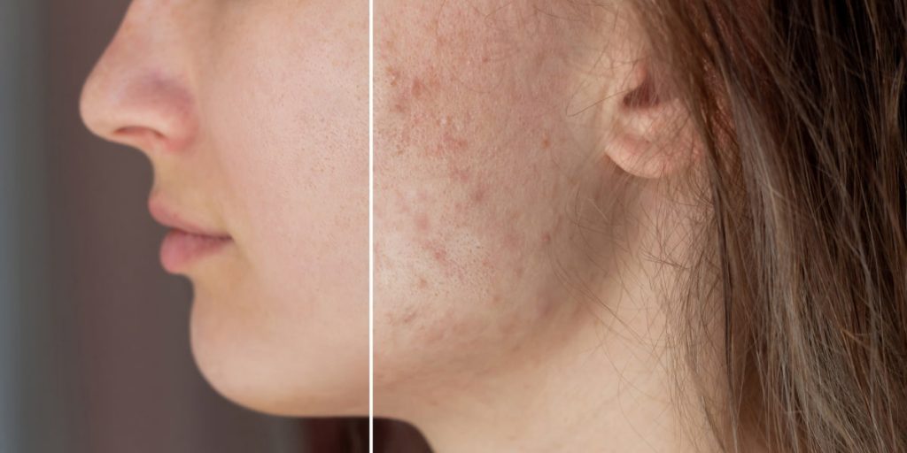 face with acne and without