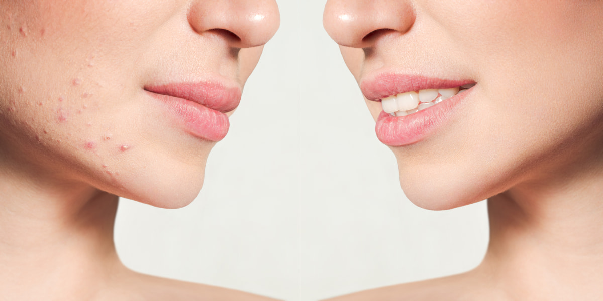 How To Cover Acne With Makeup Tips And Tricks