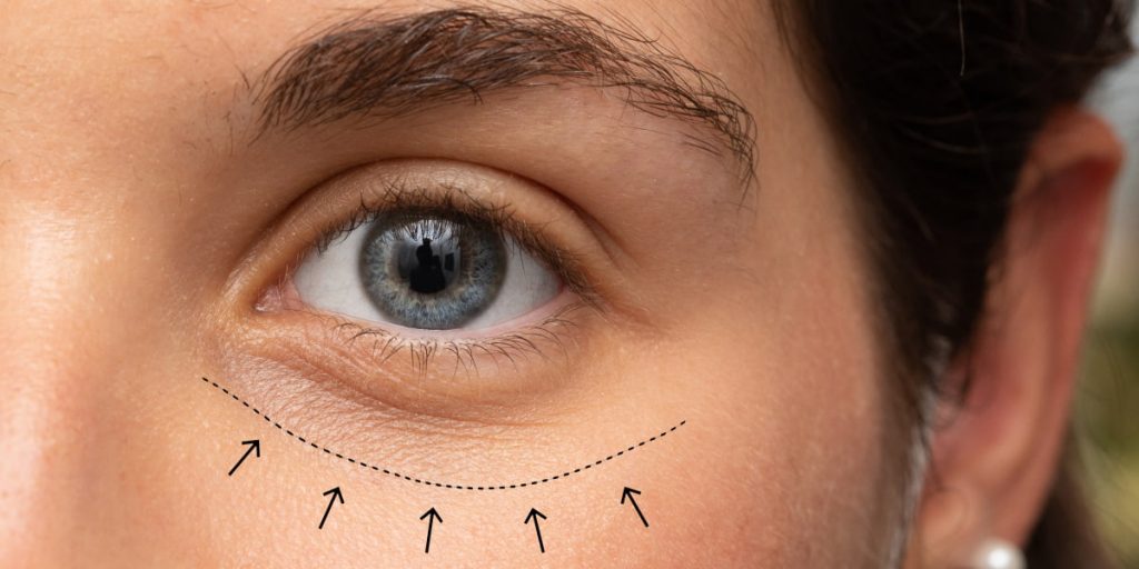 2 What Is Under Eyes Filler  1024x512 - Under-Eyes Filler: All Things You Should Know