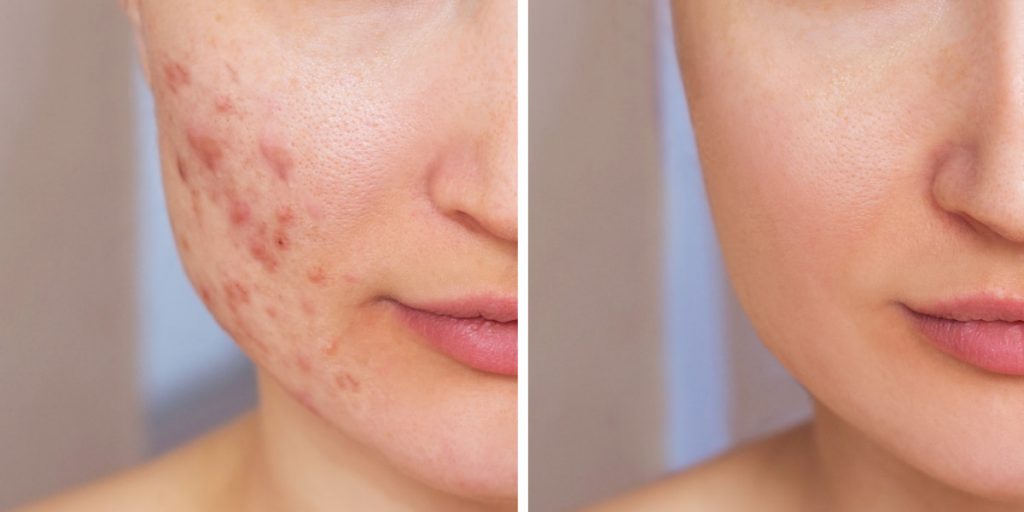 2 What are the types of acne scars for fillers treatment  1024x512 - Facial Fillers For Acne Scars: Does It Work?