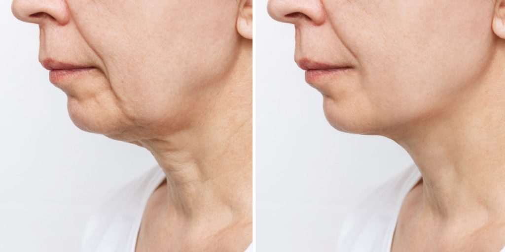 jowls before after
