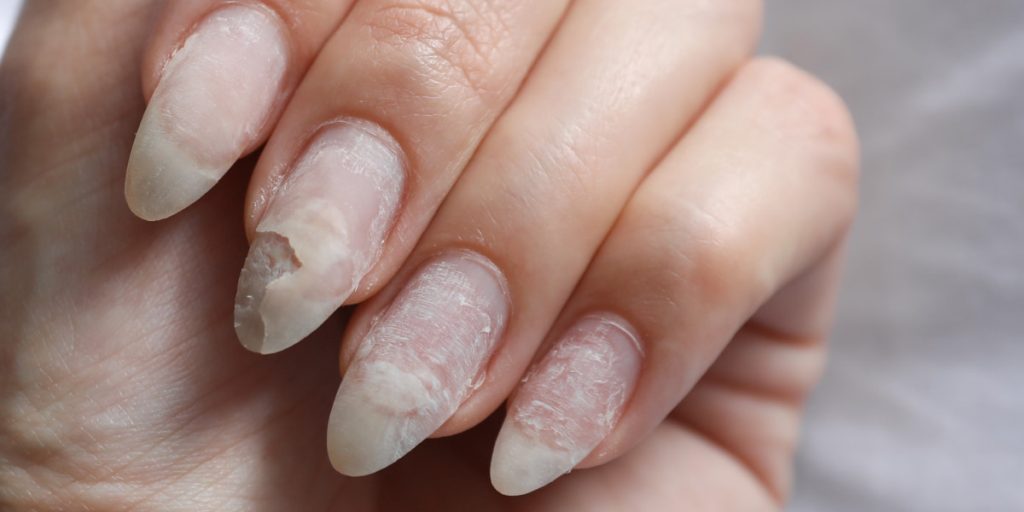 2 Treatment of peeling nails 1024x512 - How To Keep Nails From Peeling? Proven Treatment For Each Cause