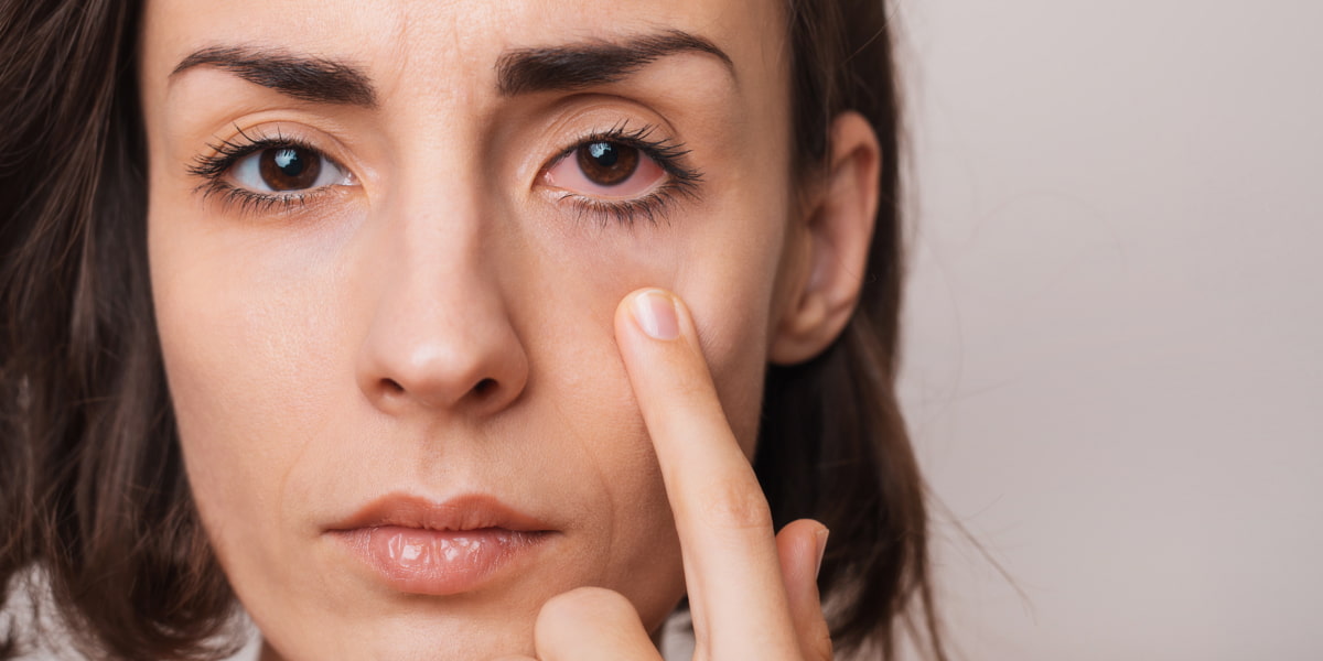 How To Make Your Eyes Whiter From Yellow And Red?